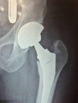 x-ray of artificial hip
