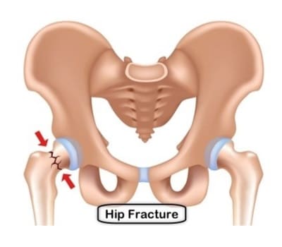 illustration of fractured hip bone