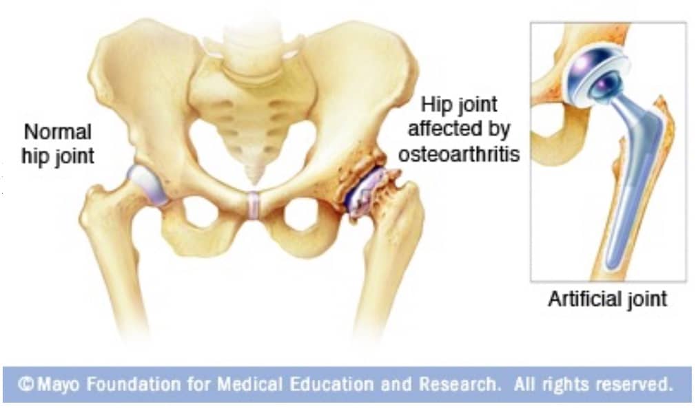illustration of hip bone with osteoarthritis next to close up of hip replacement