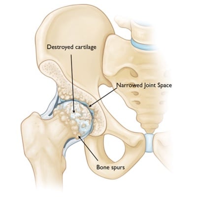 illustration of hip bone with osteoarthritis