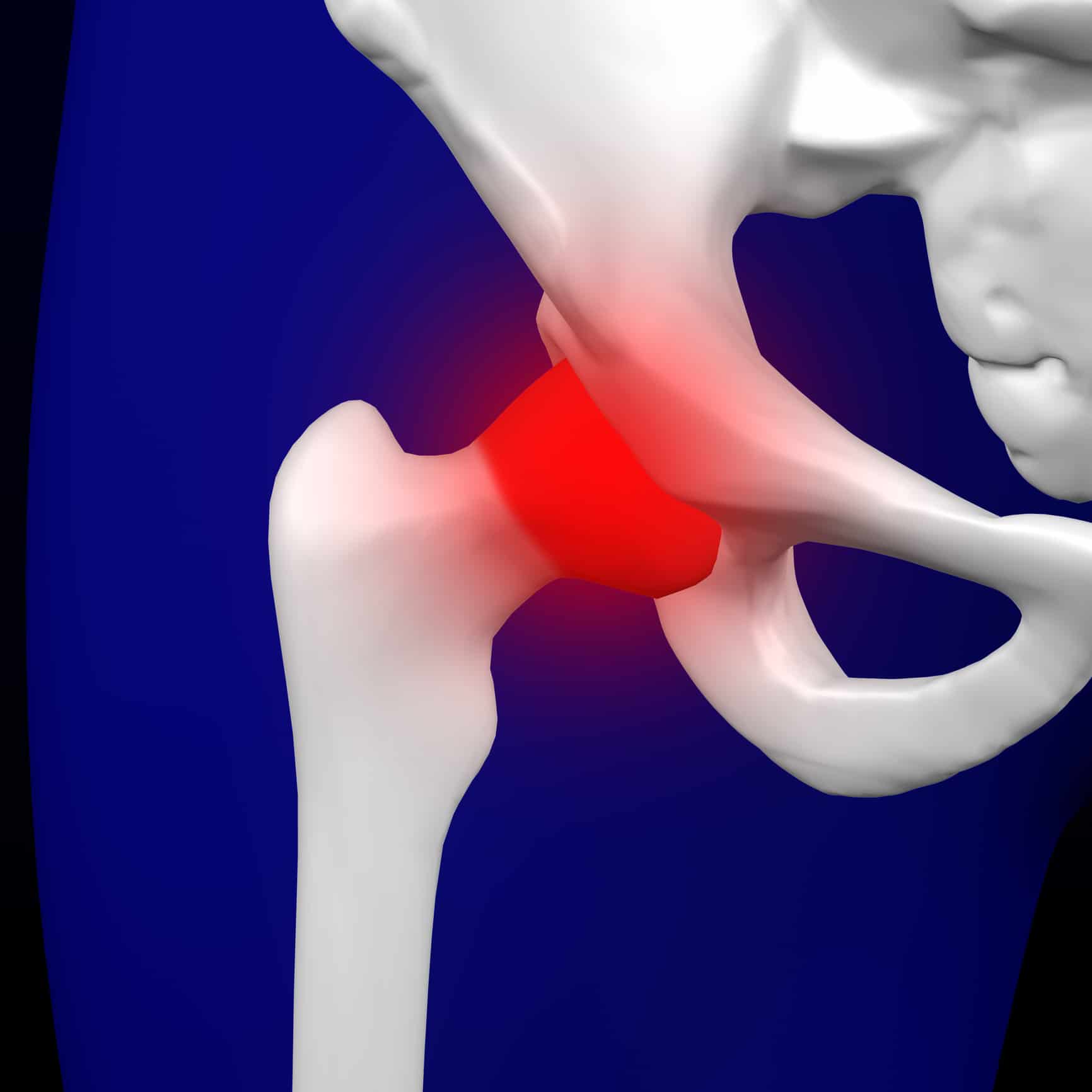 Hip Bursitis: Symptoms, Risk Factors and Complications
