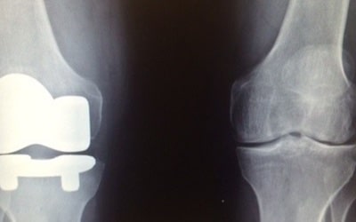 pic x ray of knee replacement dr moore patient 400 x 250