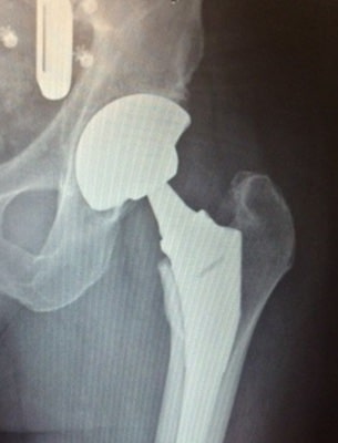 Hip Replacement Surgery Pinehurst NC