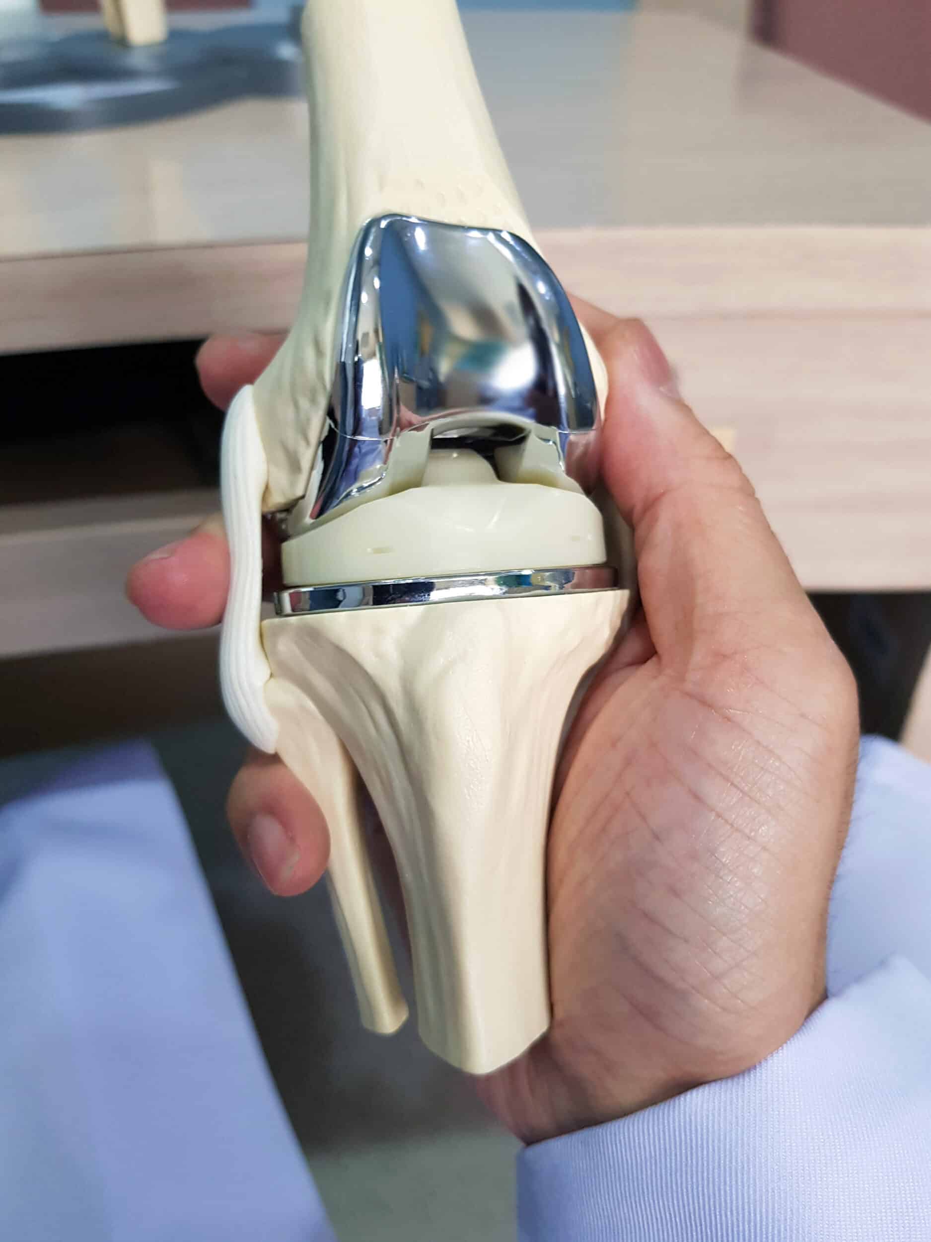 Doctor 's hand holding model of total knee replacement (TKR). Medical technology concept.