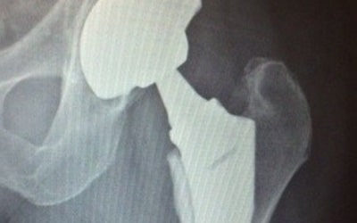 pic xray of hip replacememt dr moore 400 x 250