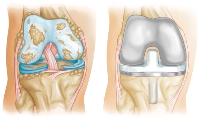 Knee-replacement-image-add_1
