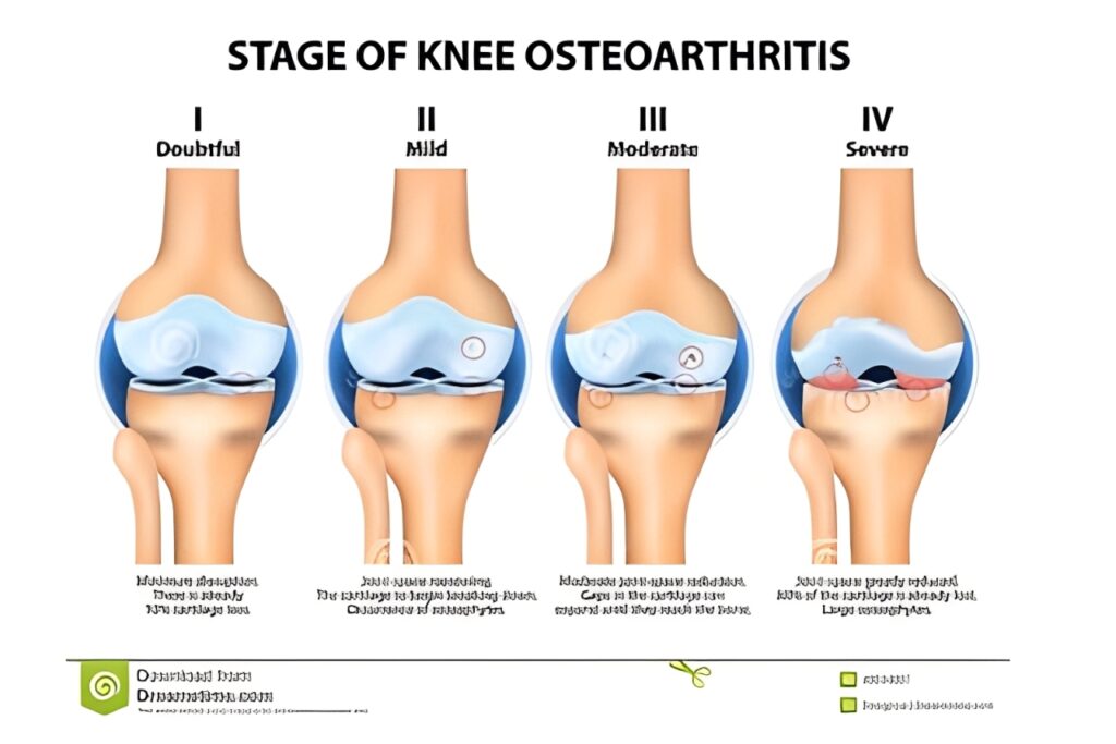 Osteoarthritis-of-the-Knee-Replacement (1)